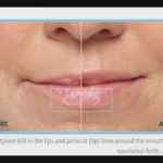 Read more about the article DERMAL FILLERS AND YOU BY ROCHELLE NICOLAS-WEDIGE, MSN, APRN